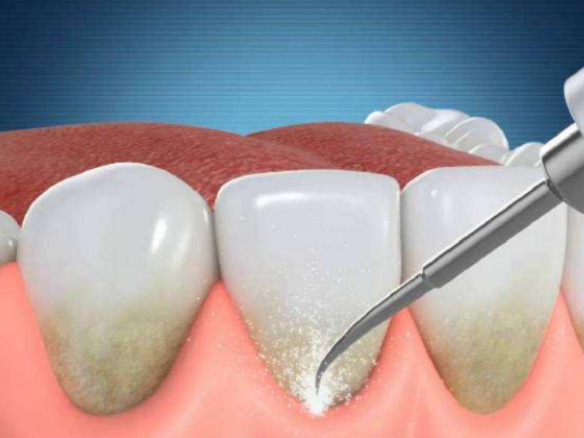 牙周夹板固定要多少钱(牙周炎危害可不小) - 价格百科