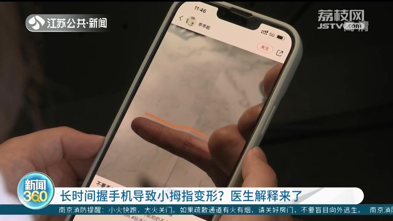 长时间握手机导致小拇指变形？医生解释来了