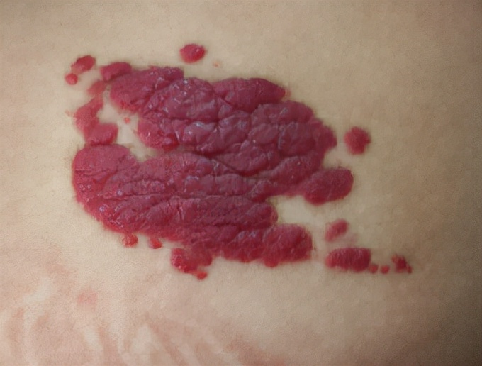 皮肤下有红色的小血点图片