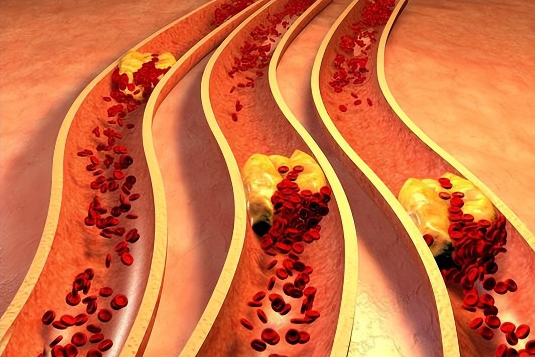 如何"消除"血管斑块?医生:记住这3点,早知早受益