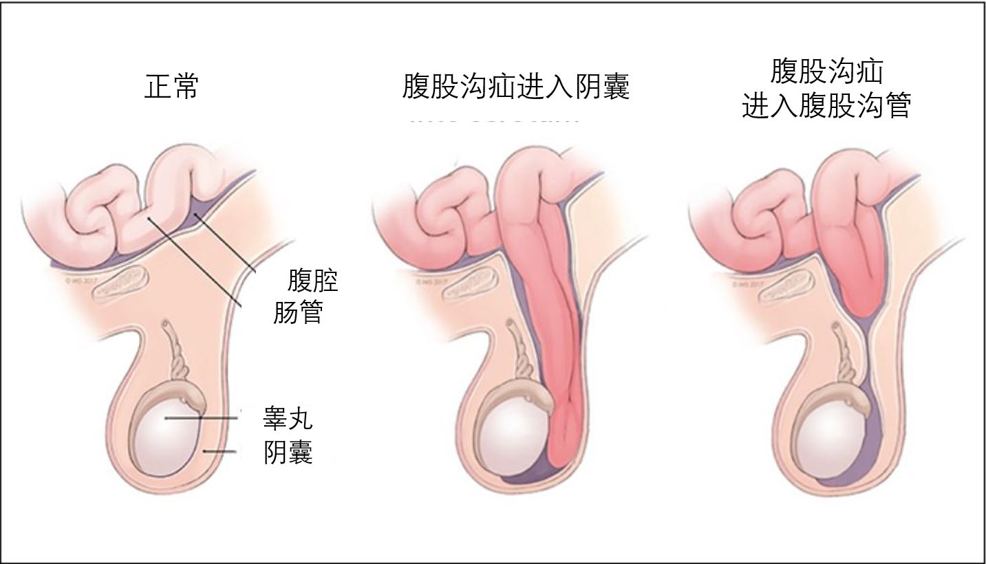 那么,如何判断宝宝是否得了疝气呢?