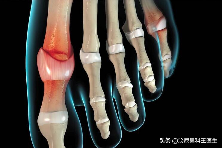 我国痛风高发，“祸根”是豆制品？其实这3种食物才是害人精