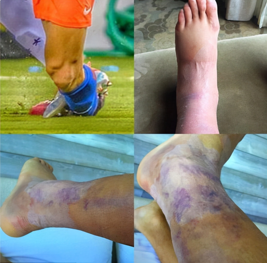 足球运动员容易哪里受伤(内马尔重伤退场,脚踝变形90度,足球运动员