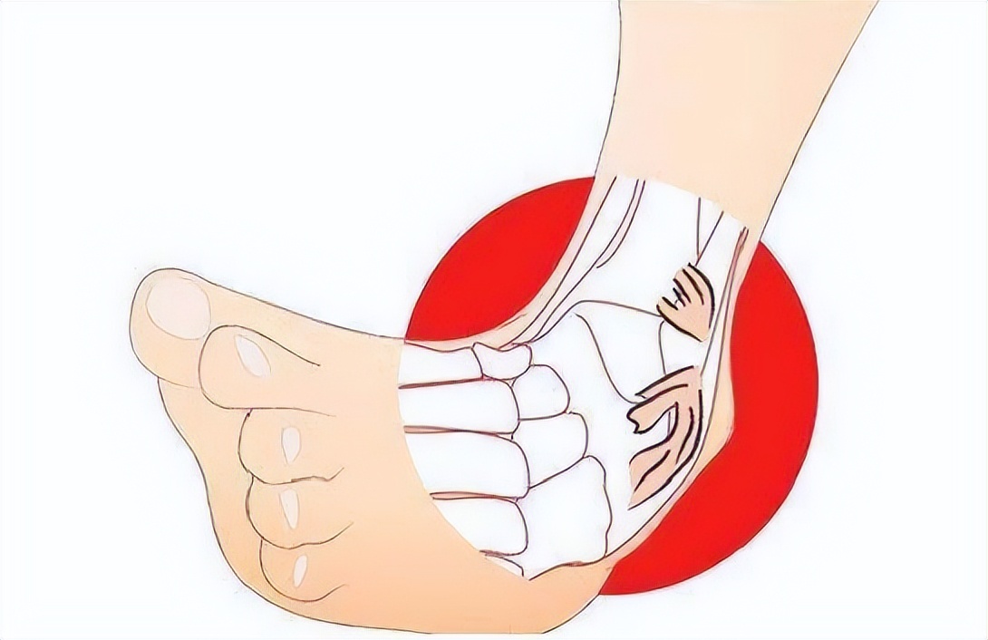 踢足球脚崴了多久能好(脚崴了应该怎么办?