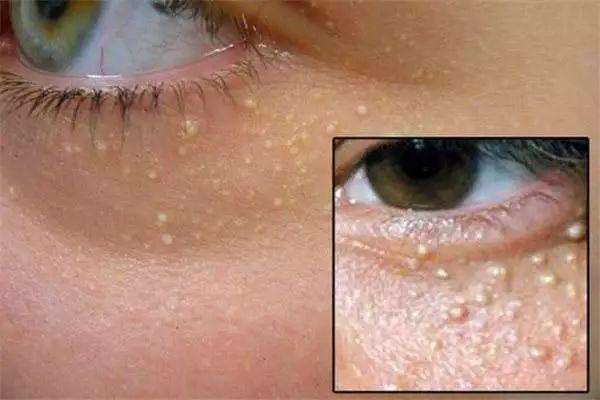 什么是脂肪粒简单地来描述一下,它是一种长在皮肤上的白色小疙瘩,约