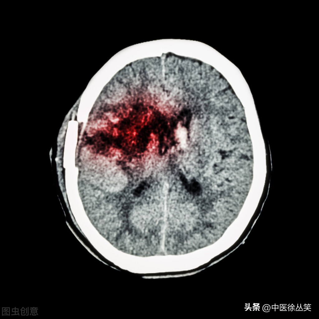 中将身份证(一位脑出血患者的亲身经历，深渊的尽头有黎明)