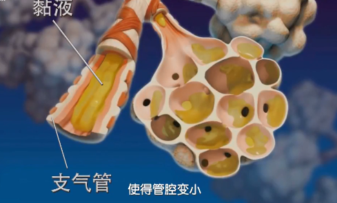 咳嗽不止，缠绵反复，从没想过是哮喘？不妨简单自我测试一下