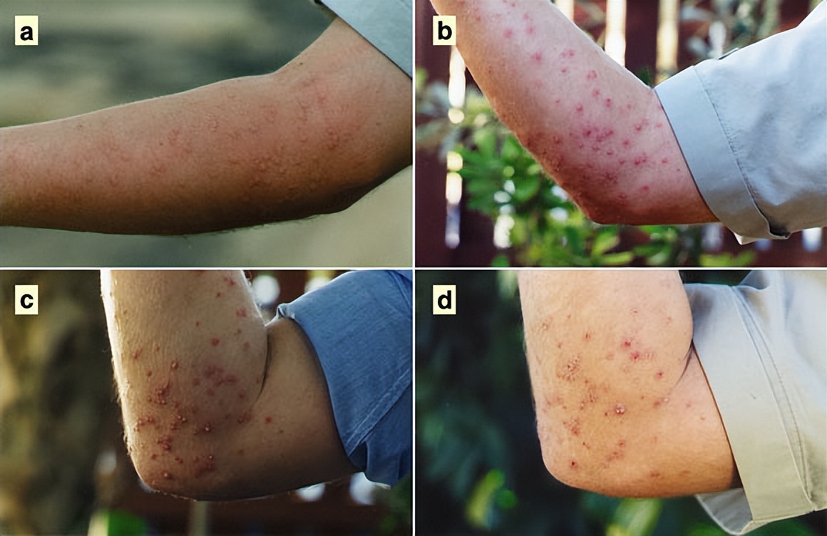 被蜇伤后的少部分体质过敏者有晕眩昏迷的现象需送医急救,大部分伤者