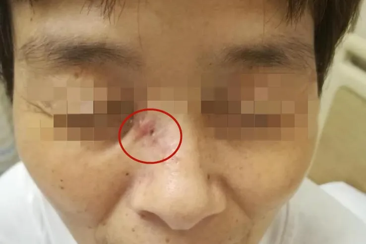 鼻头一粒小疙瘩,几年长成黑色“乒乓球”,一查竟是癌