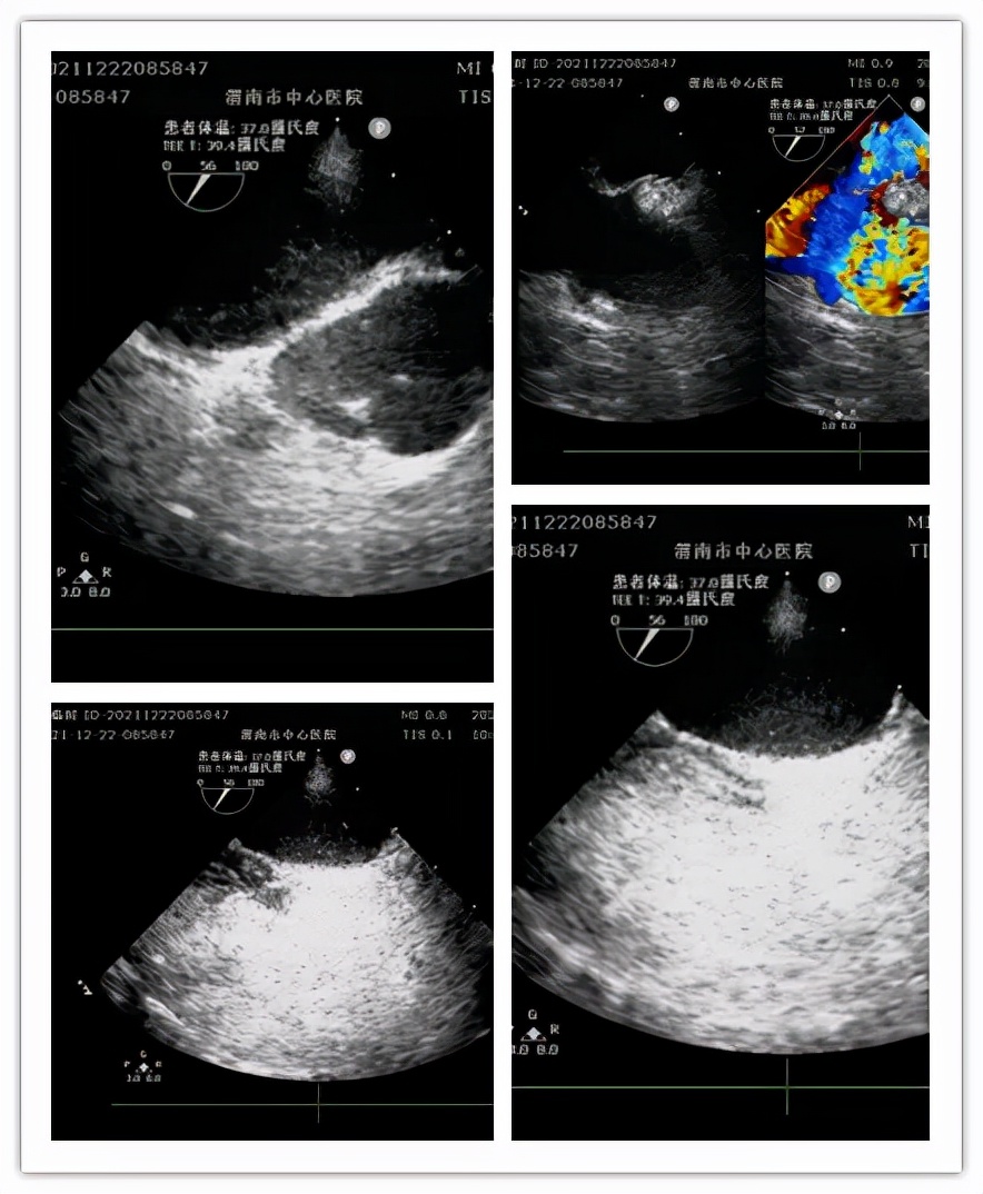 渭南市中心医院成功开展首例超声科门诊经食管超声心动图