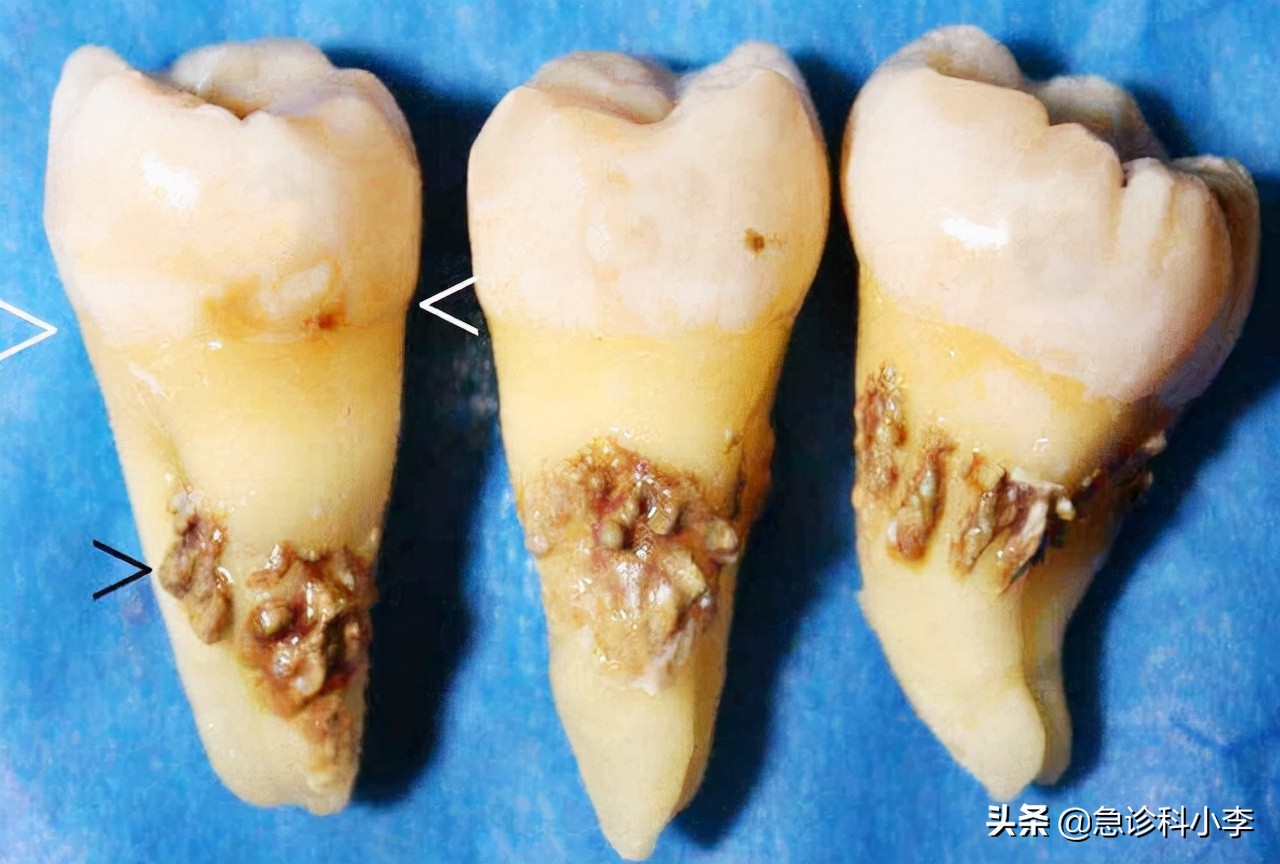 牙缝里的牙结石，如何清除干净？3个办法是不少人的选择