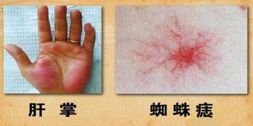 有蜘蛛痣就是有肝病了？数量多颜色深是病情加重？如何才能消失？