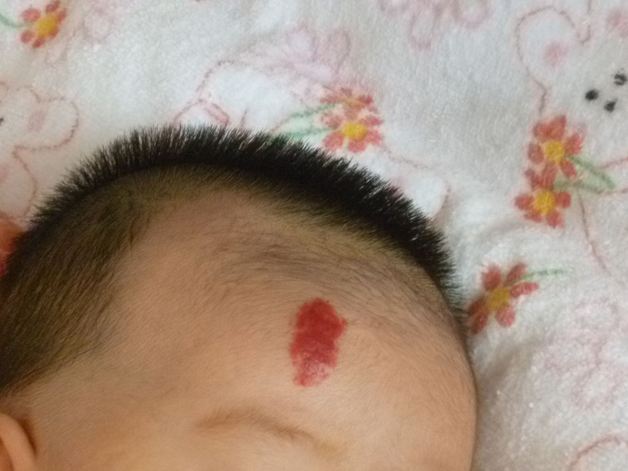 婴儿出血点怎么回事(0) - 乐宝宝贝