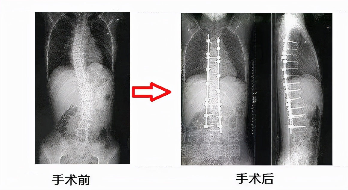 驼背手术图片图片