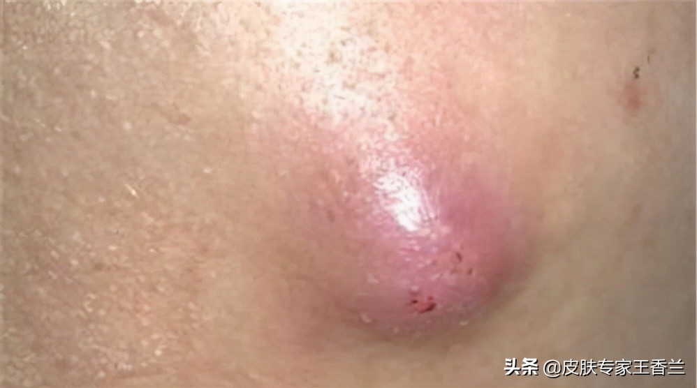 起初局部出现红,肿,热,痛的小硬结,以后逐渐肿大,呈圆锥形隆起.