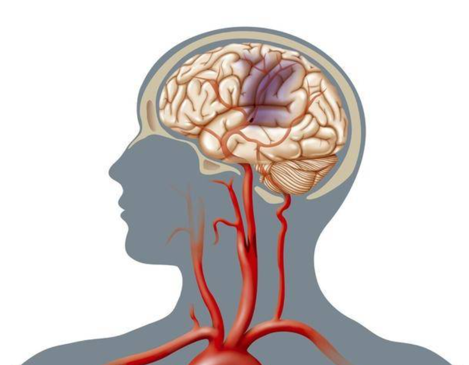 的是大脑由于不能及时得到血液的供给而无法正常工作,大量脑细胞死亡