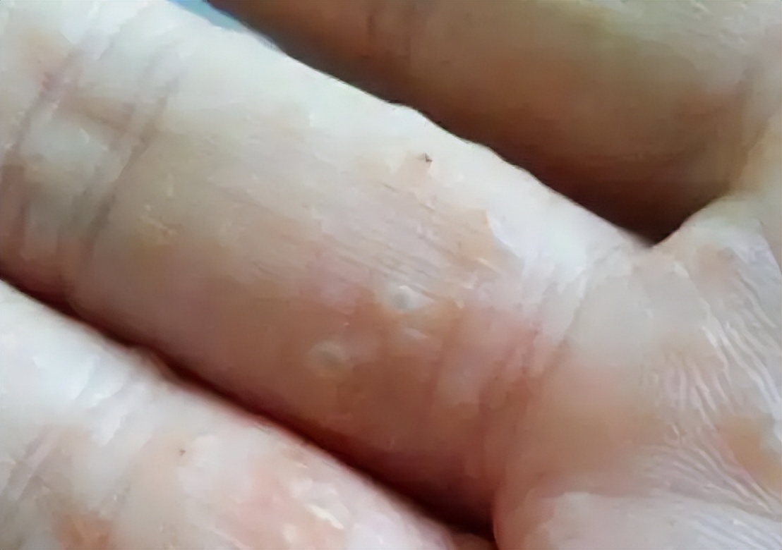 手上长透明小水泡是上火吗?或许很多人想错了,其实是它在作怪