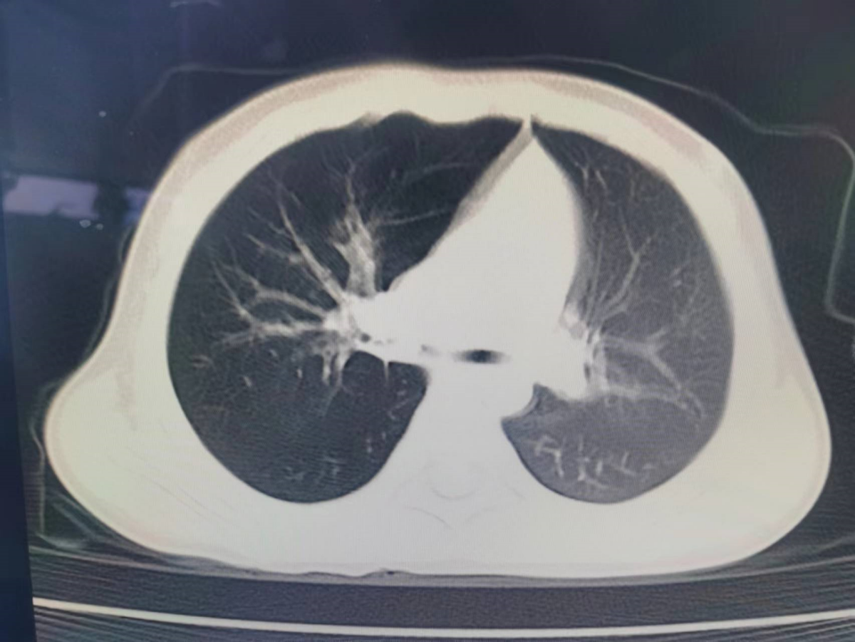 气管异物诡秘凶险，华西二院眉山市妇女儿童医院技术精良明察秋毫
