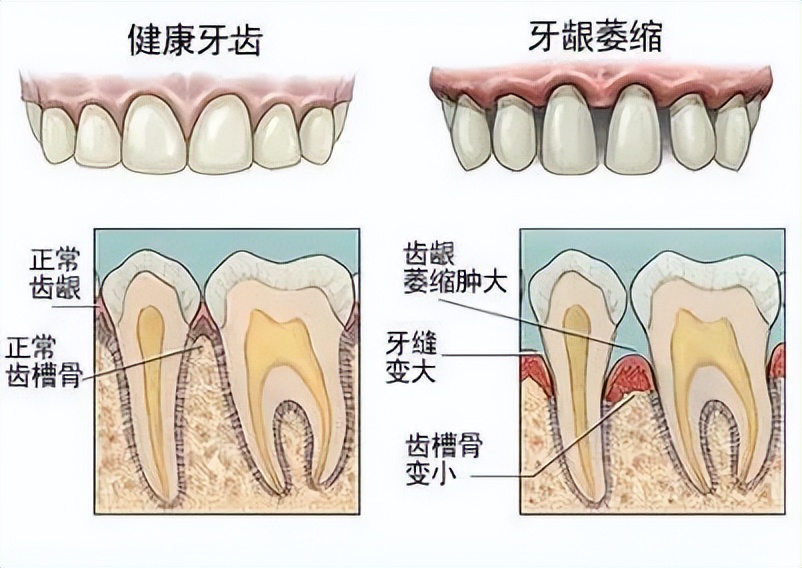 牙齦萎縮是怎麼引起的？