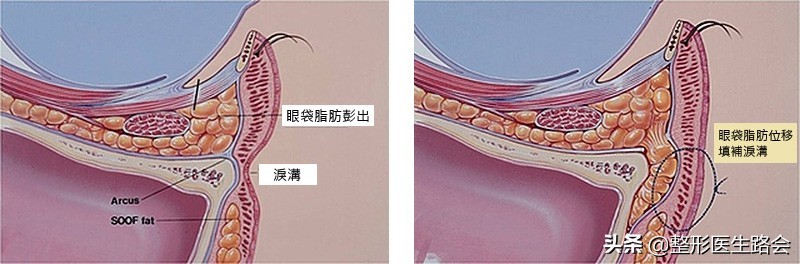 做内吸去眼袋失败后，方才明白的6件事