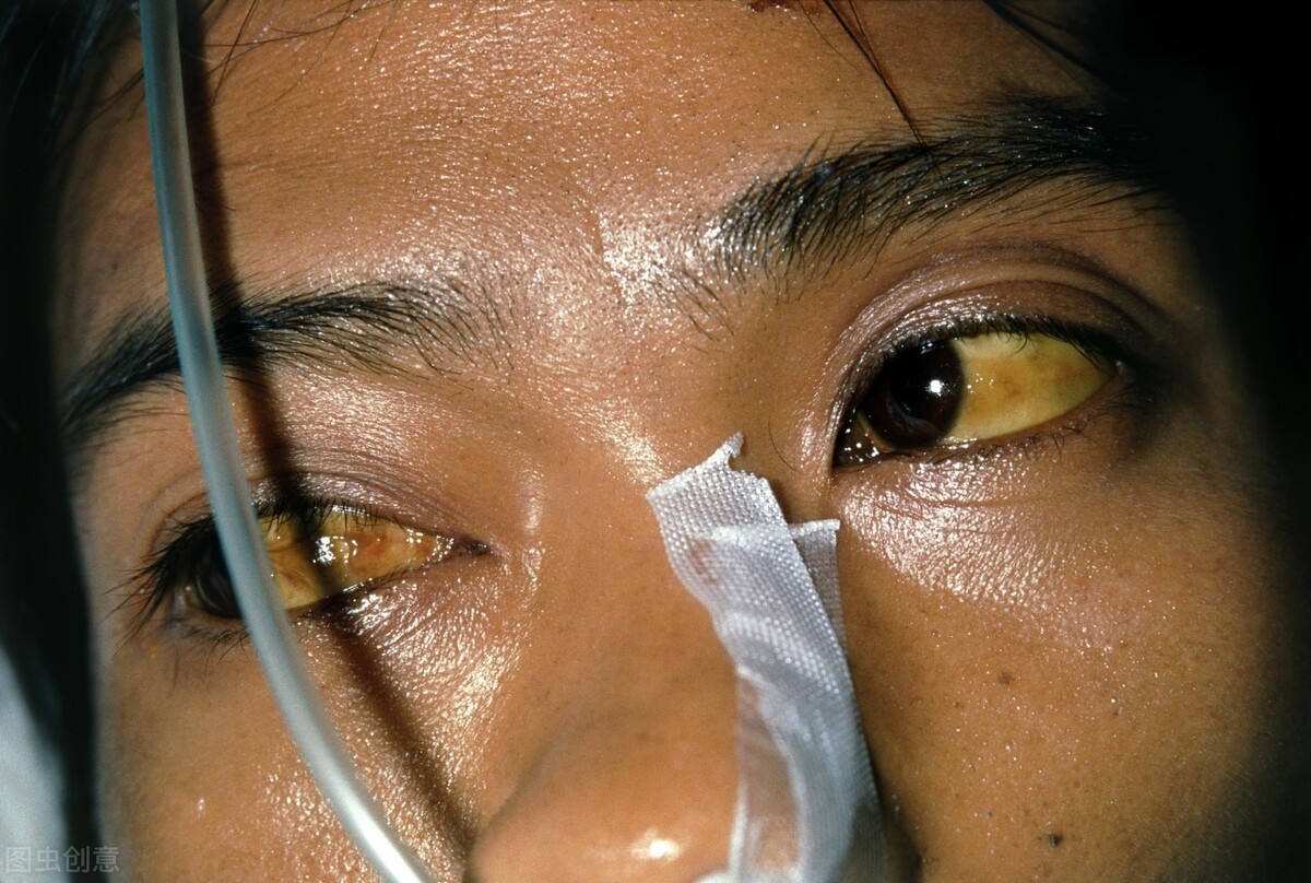 眼白出现这几种颜色,该注意了