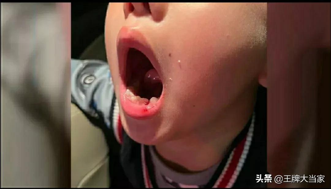 6岁男童被钢琴老师扇掉一颗牙（这个老师一定要赔礼道歉）