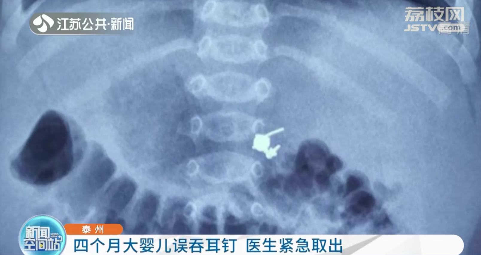 泰州4个月宝宝扯下奶奶耳坠吞下肚 医生胃镜手术取出