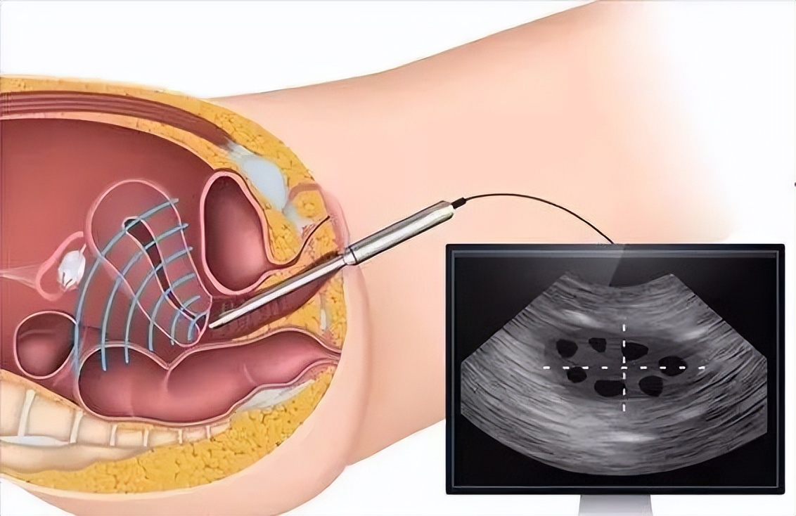 经阴道b超能看到什么?看不到什么?