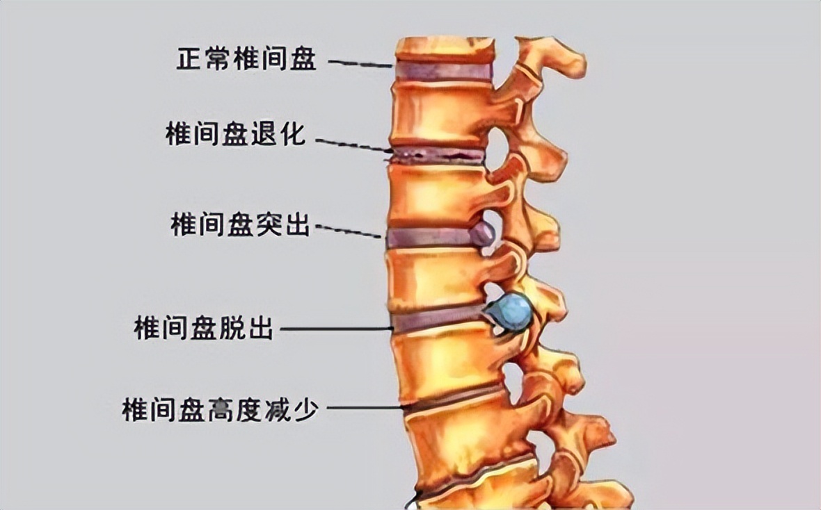 腰椎間盤突出的典型6大症狀,6種預防辦法,一套簡單腰背肌鍛鍊操