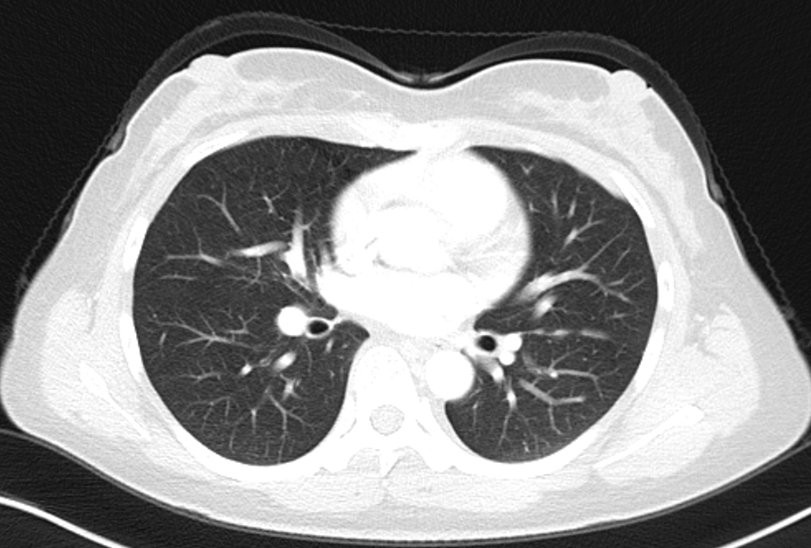 晚期肺癌的长期生存在坚持与关爱中实现