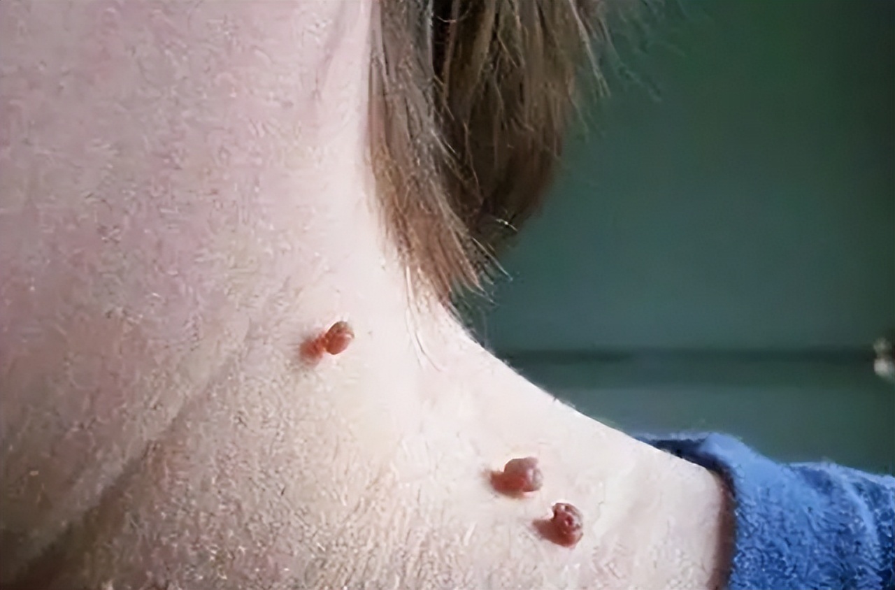 腋下长痘痘是怎么回事不痛不痒(腋下长疣是什么原因)_友友