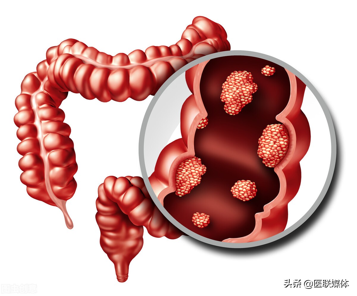 若想远离直肠癌，饮食记住3不要，晚上3坚持，请你做好