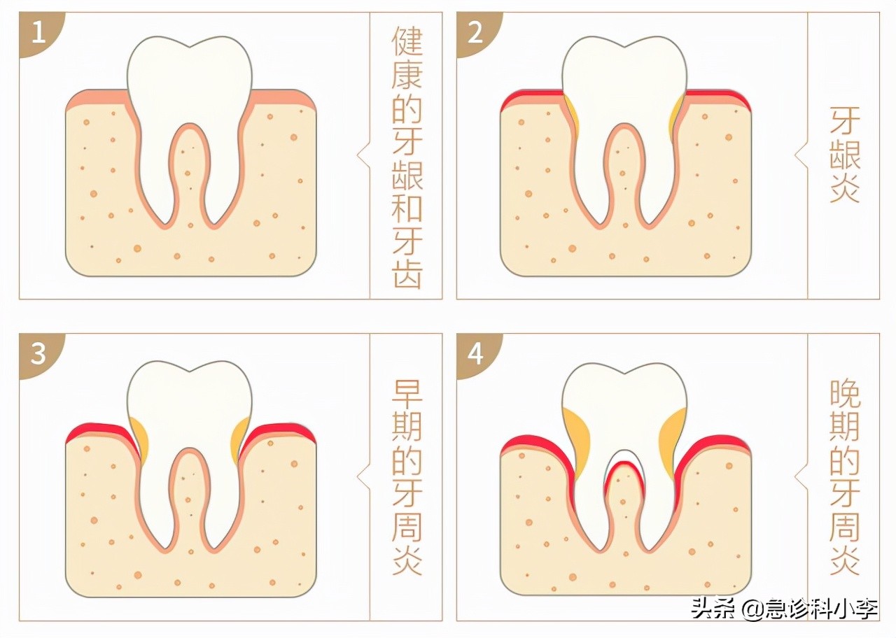 牙缝里的牙结石，如何清除干净？3个办法是不少人的选择