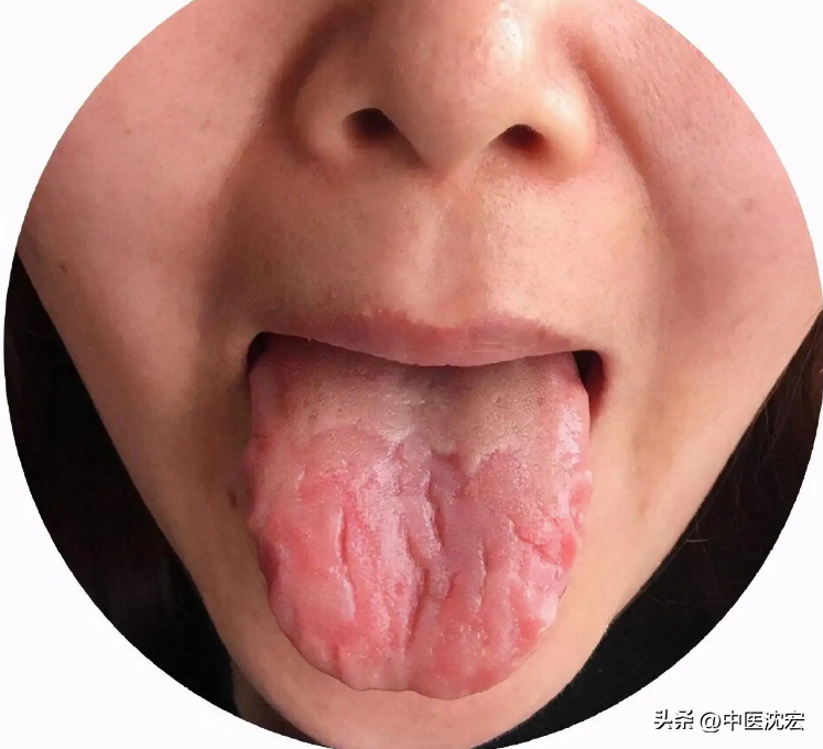 舌头中间有裂纹是怎么回事（舌头有裂纹？可能是脾虚，2味药，一补一泄，健脾祛湿 赶跑裂纹舌）