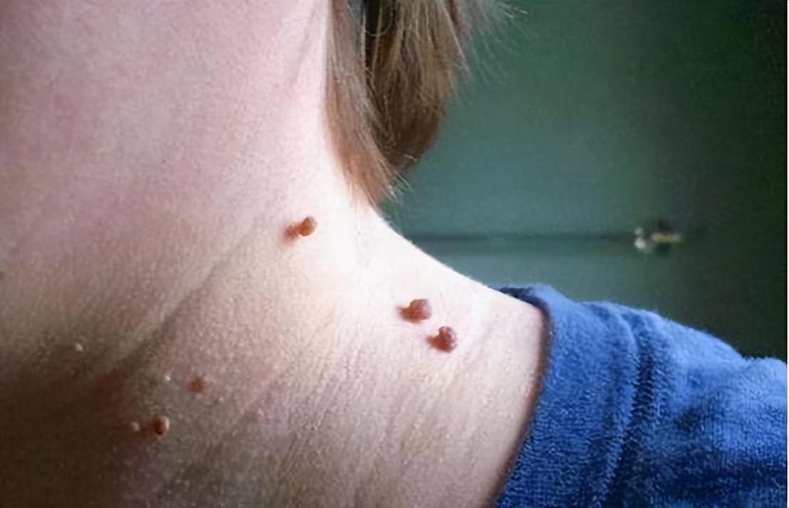 想用手揪掉它,却又不敢,甚至还怀疑自己是感染了hpv,所以才会长肉疙瘩