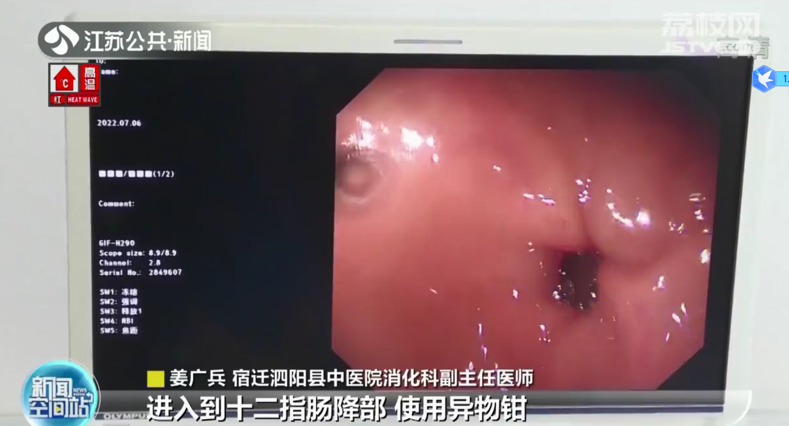 宿迁泗阳：男子喝酒误吞7cm牙签 肚痛3天肠子被刺穿