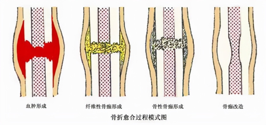 为何有些骨折疼痛难忍，却不能立即做手术？听听医生怎么解释