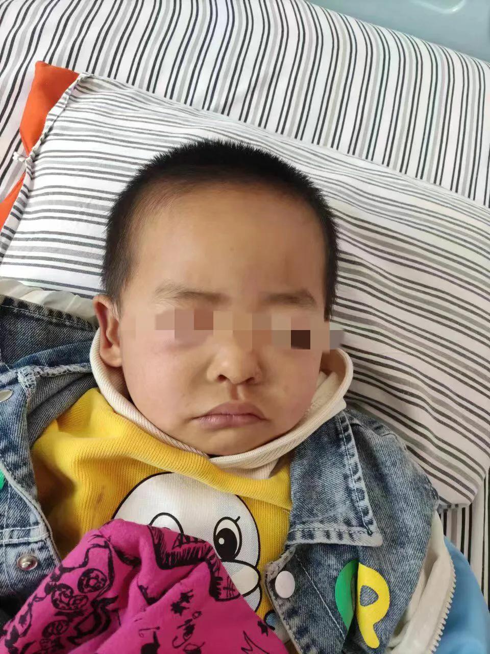 科普2歲7個月男孩患腎病綜合徵陰囊眼瞼雙下肢全身水腫