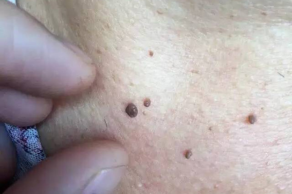 皮肤上突然长出的小肉球，是什么东西？了解6种可能，有好有坏