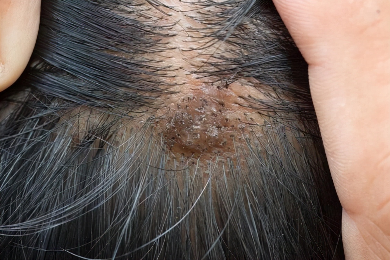 头部脂溢性皮炎图片(头皮上长出的脓包与疙瘩是什么物质) - 赤虎壹号