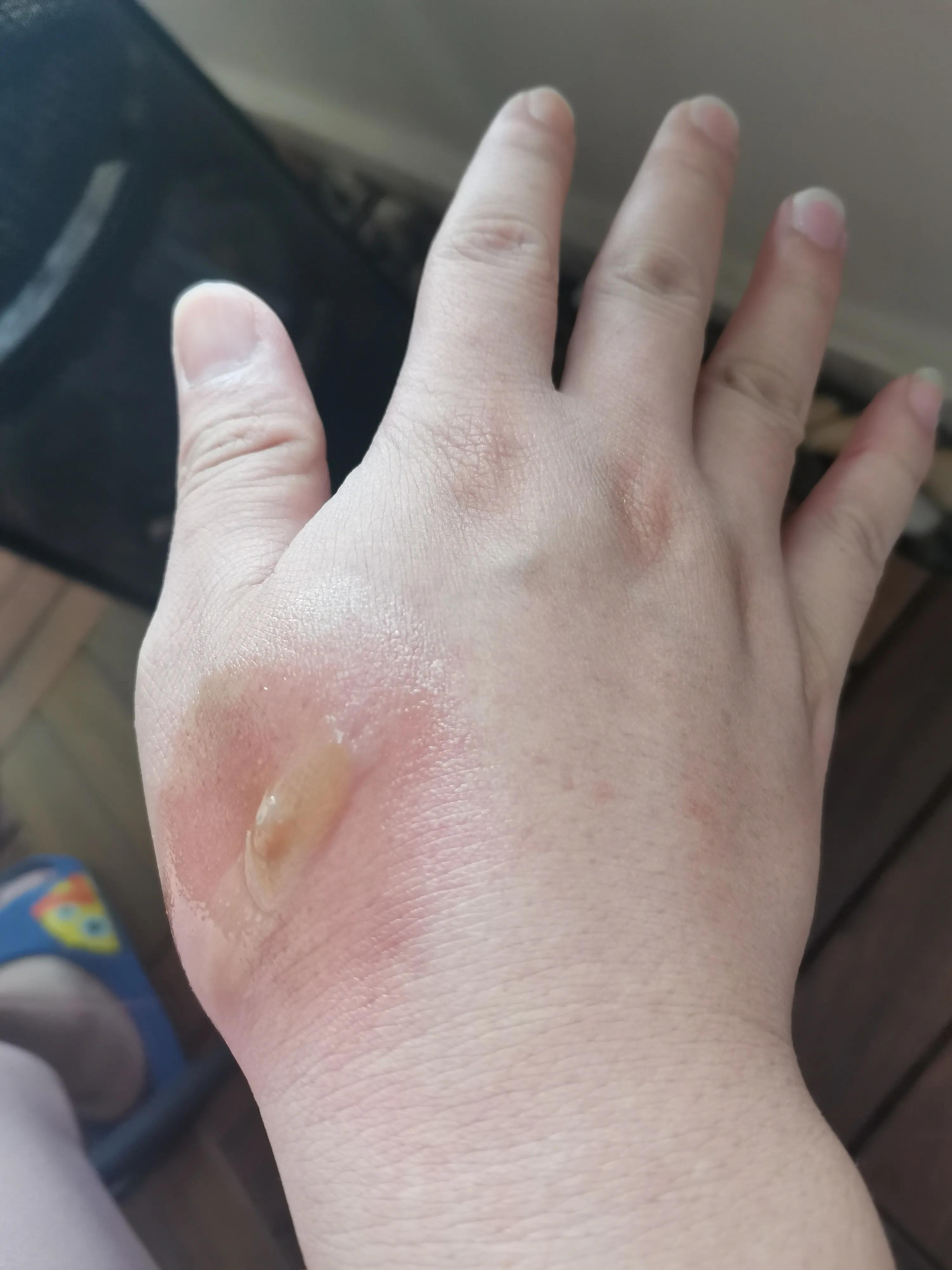 记录烫伤恢复过程