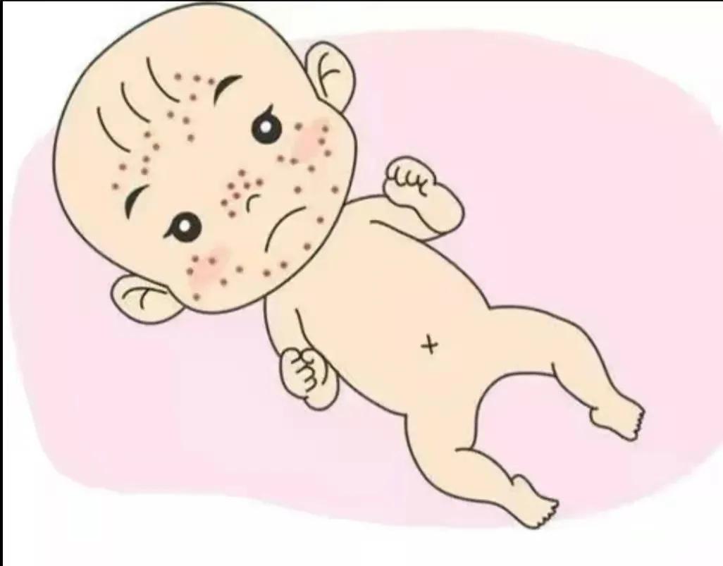 新生儿粟粒疹怎么治疗图片