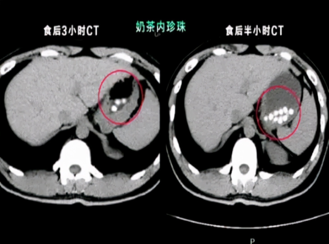 CT做多了会致癌？做一次CT，对人体的伤害有多大？你知道真相吗？