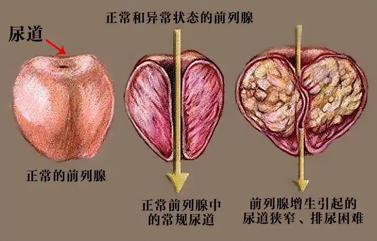 郑州看男科哪里好(「我不说，你不知道」郑州大学二附院治疗前列腺有妙招)