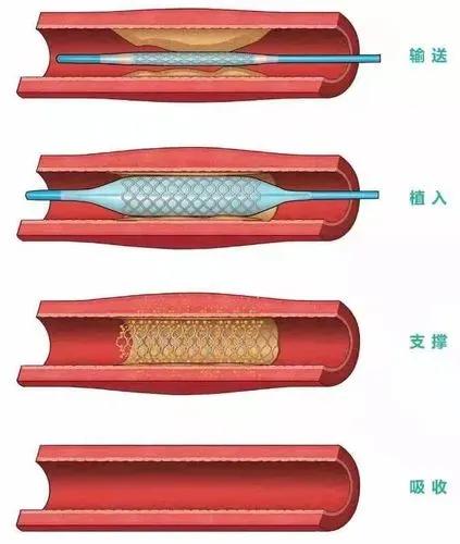 心臟支架手術後能活幾年?醫生:做好這4點,活30,40年都正常