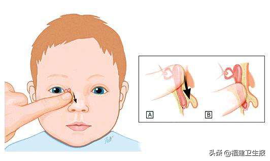 妈妈多留意！宝宝眼睛水汪汪，可能不是萌，而是一种病