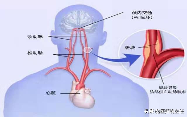 55岁大叔“斑块”消失，他坚持的3大习惯值得借鉴