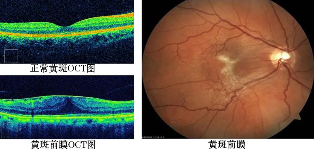 黄斑前膜黄斑区多长了一层膜严重损害视力