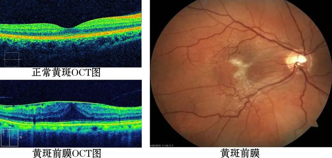 黄斑前膜 