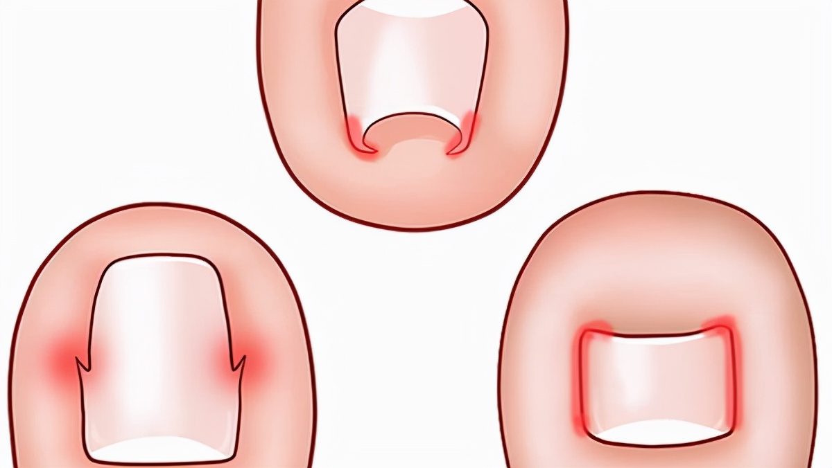 趾甲老往肉里钻，一碰就疼？医生：得了甲沟炎治疗有方法